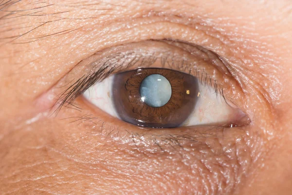 Cataract