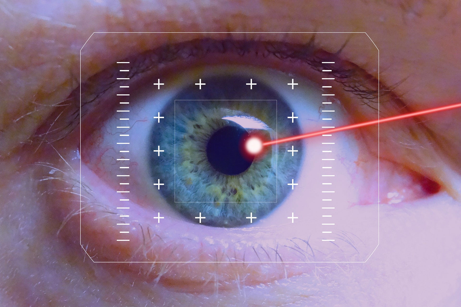 LASIK Eye Surgery
